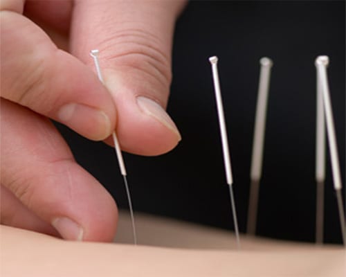 acupuncture copy2