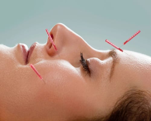 facial-acupuncture